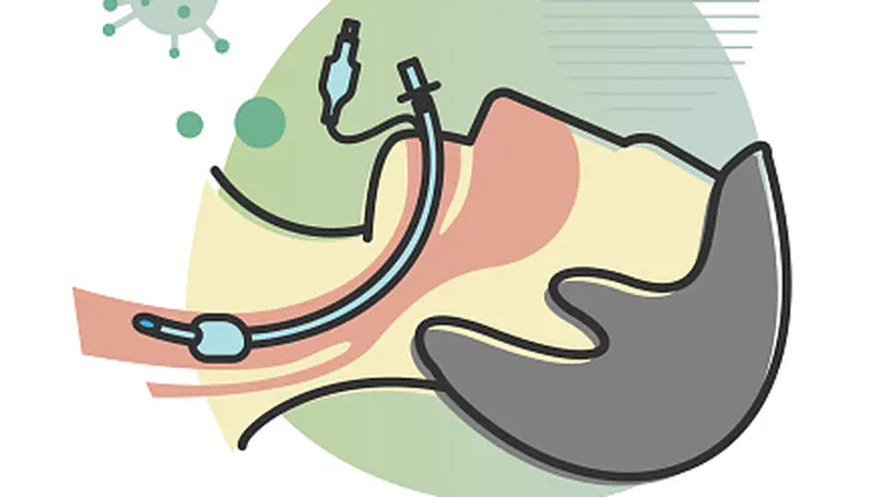 Intubation Prediction